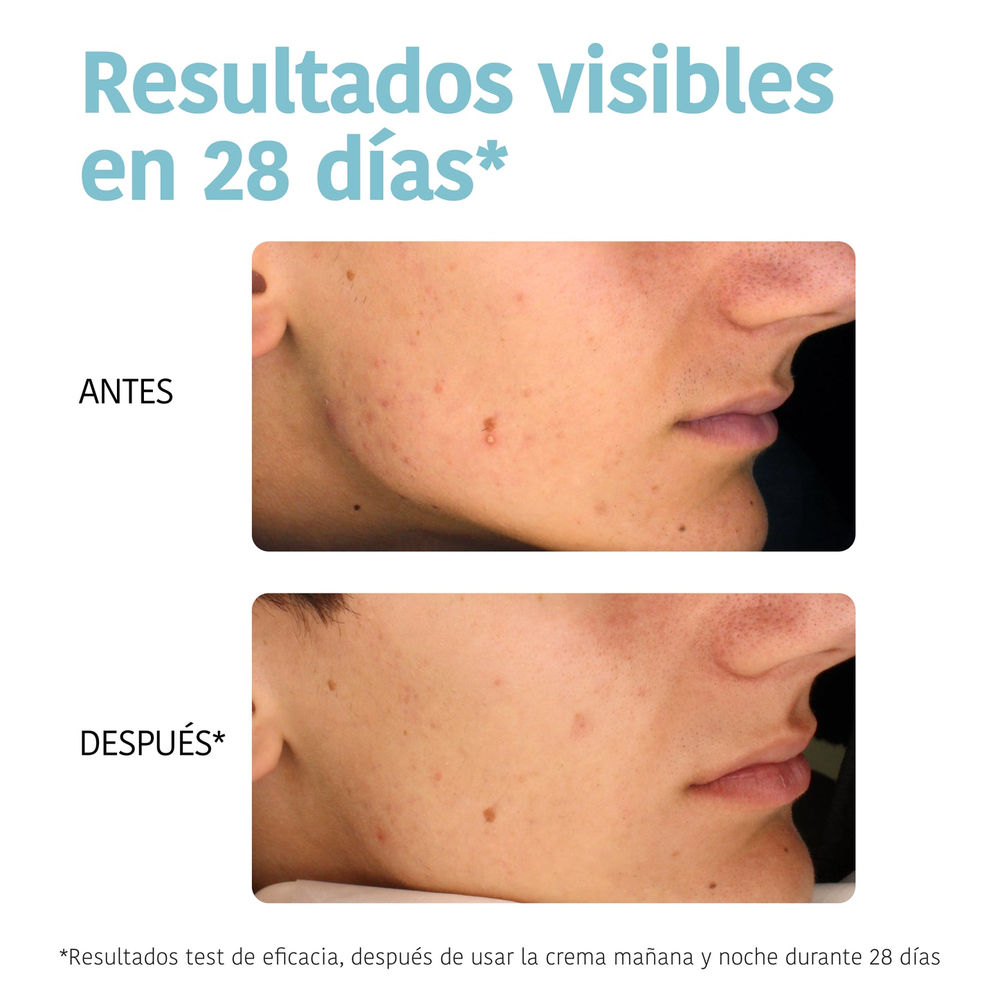 Crema Oil Control - Acne
