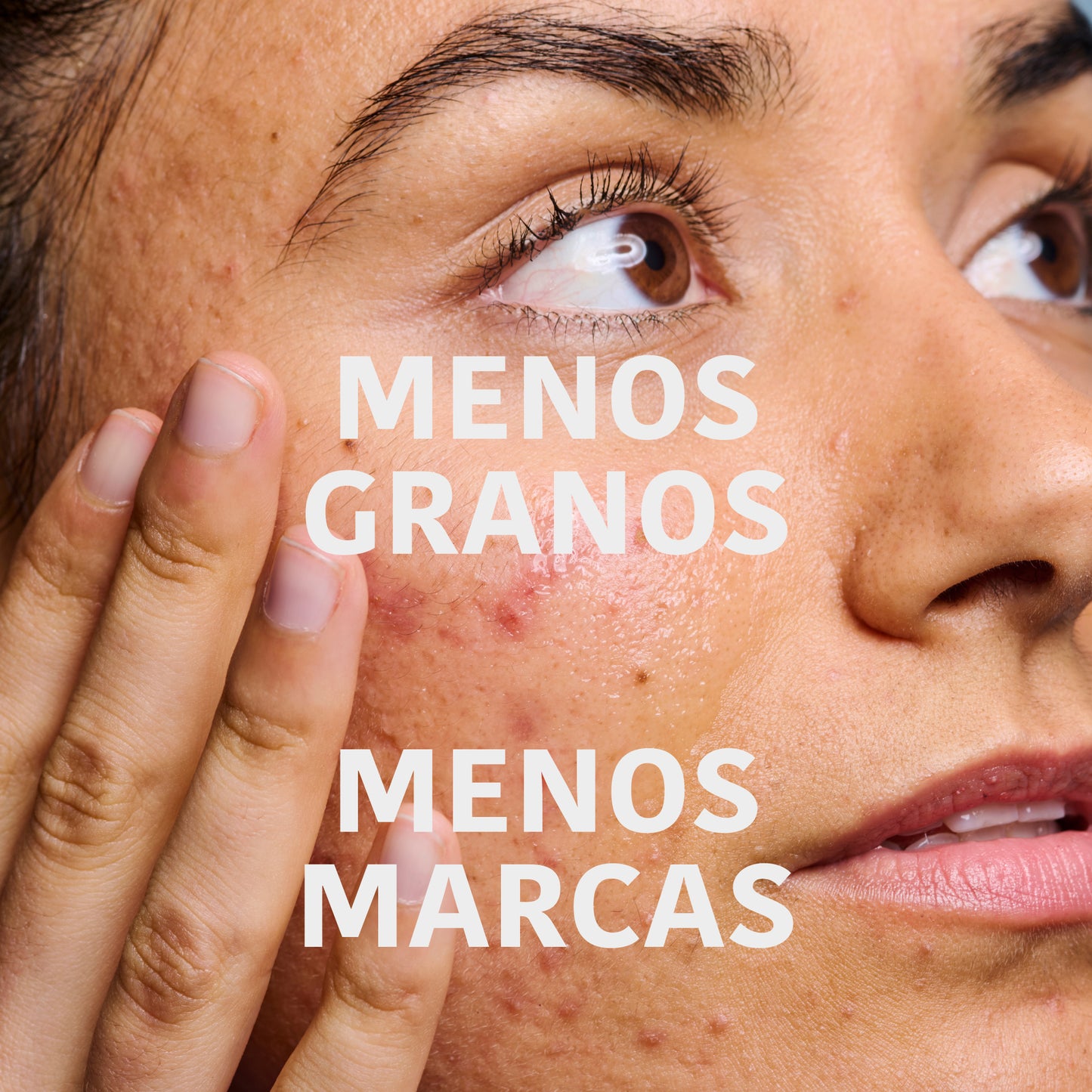 Prevent & Correct Anti-Blemish Serum