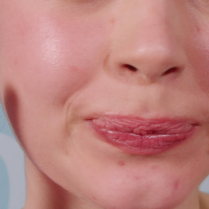 FUN Pimple Patches with Salicylic Acid